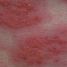 dermatitis